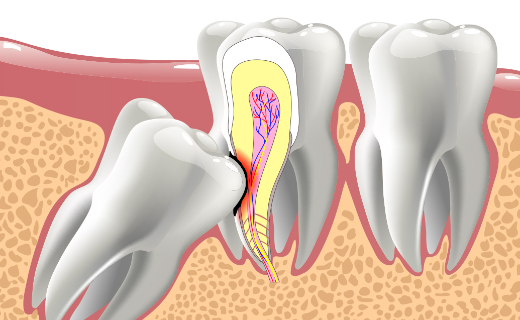 blog inner thumb :Olive Tree Dental