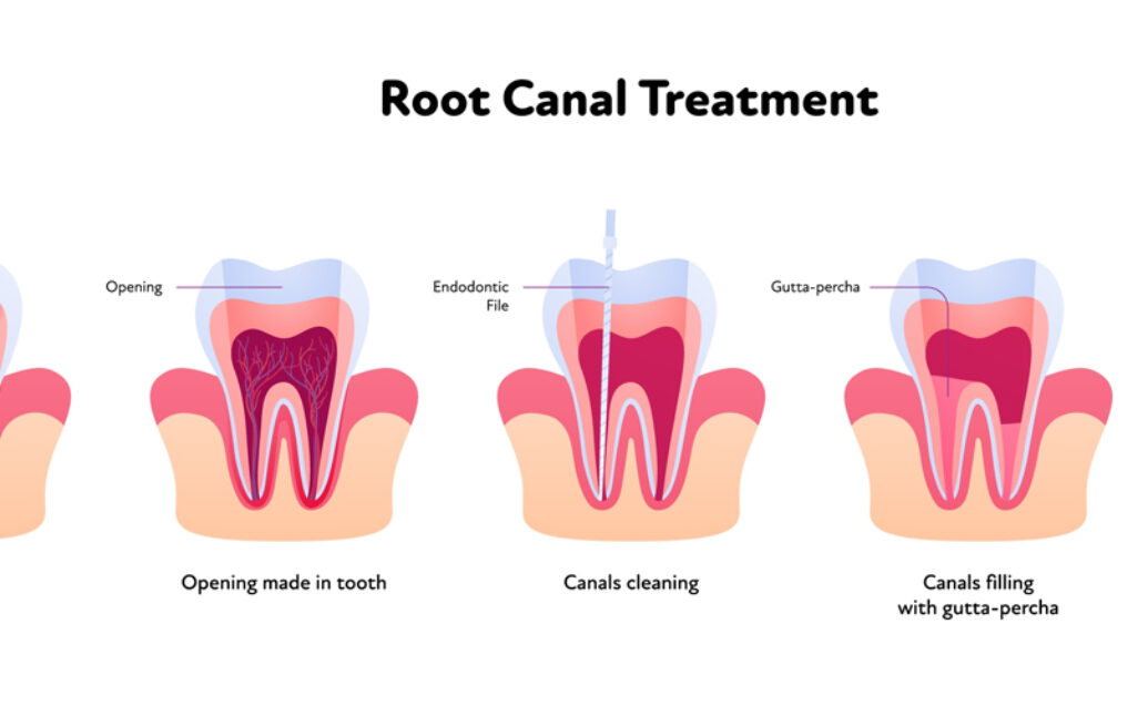 blog inner thumb :Olive Tree Dental