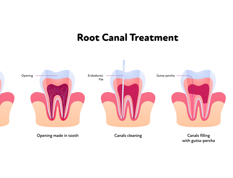 blog - Olive Tree Dental